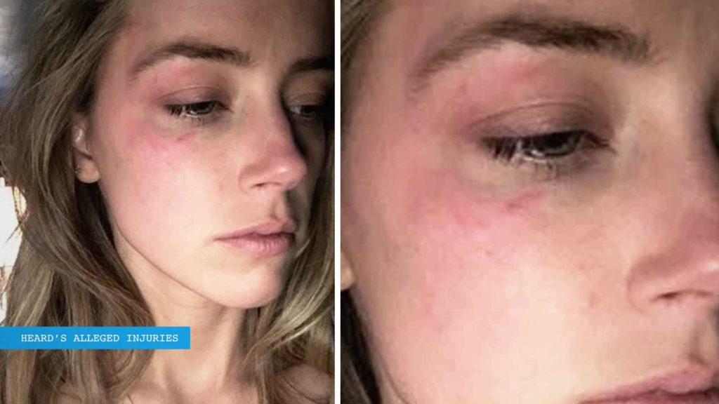 Amber Heard alleged injuries