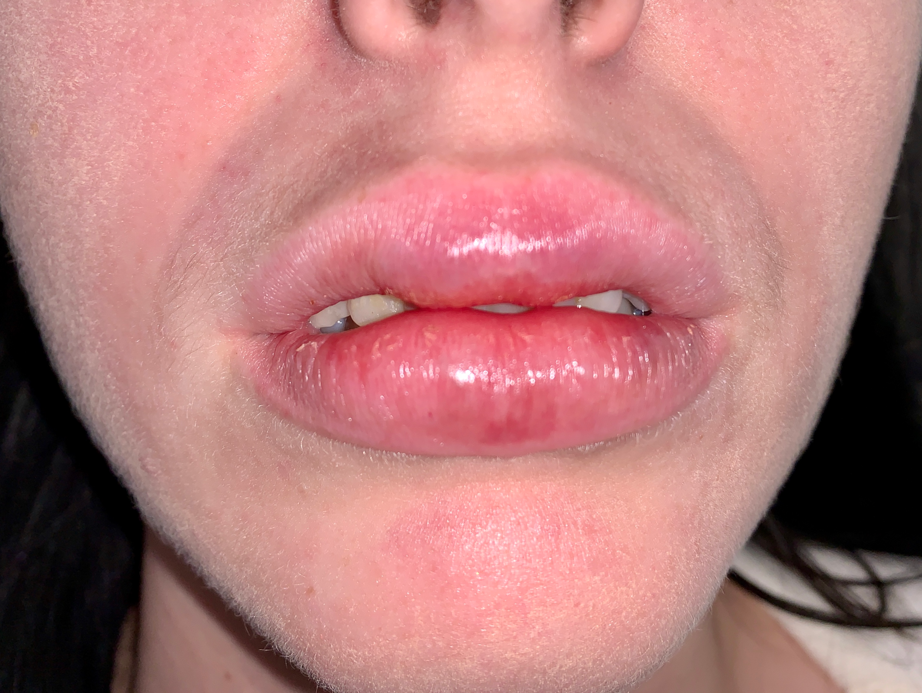 '90 Day Fiancé' Star Suffers Horrifying Injury After Botched Lip ...